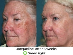 6 weeks after green light therapy