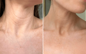 Reduction in wrinkles after red light therapy