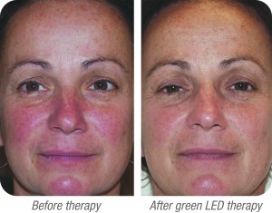 Before and after led green light therapy photos of a woman’s face
