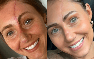 6 weeks after using red light therapy